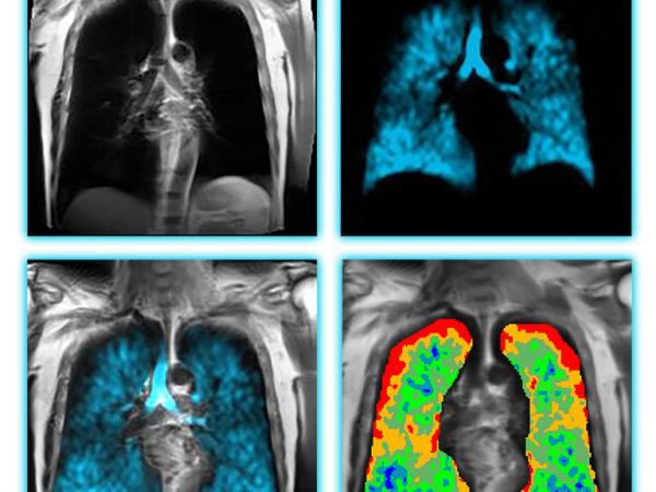 Xenon MRI XENOVIEW